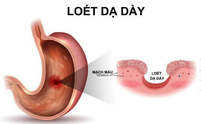 Nội soi đường tiêu hóa trên: Những điều cần biết