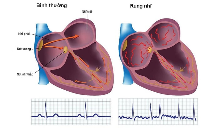 Người cao tuổi cần tầm soát thường xuyên để phát hiện sớm bệnh rung nhĩ (ảnh minh họa)