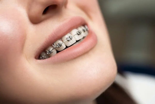 Một số lưu ý khi niềng răng để hàm răng luôn trắng khoẻ- Ảnh 3. Một số lưu ý khi niềng răng để hàm răng luôn trắng khoẻ- Ảnh 3.
