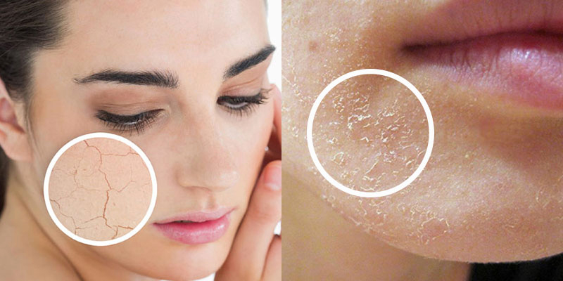 Cách khắc phục, chăm sóc da khô sần- Ảnh 1. Cách khắc phục, chăm sóc da khô sần- Ảnh 1.