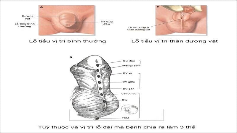 1-benh-ly-lo-tieu-thap-o-tre-em.jpg