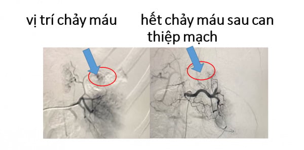 Hình ảnh chụp mạch máu xóa nền DSA hệ động mạch lách