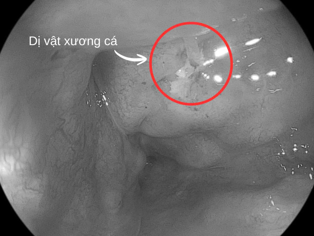 Nam bệnh nhân 32 tuổi vô tình nuốt phải xương cá basa khi ăn