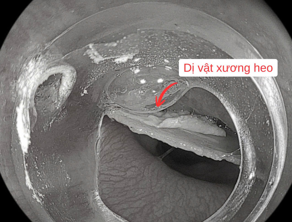 Nam bệnh nhi 9 tuổi trong lúc ăn canh nấu xương heo do húp vội đã nuốt phải một mảnh xương lớn