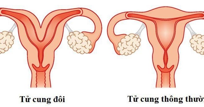 benh-tu-cung-doi.jpg