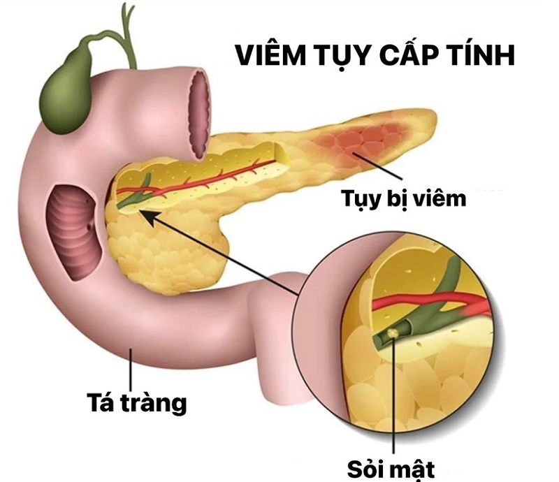 viem-tuy-cap.jpg