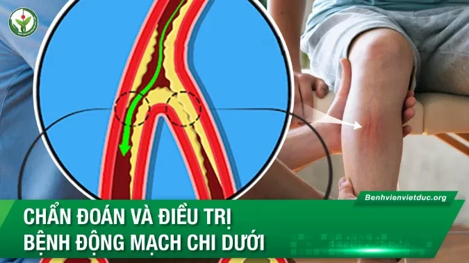Chẩn đoán và điều trị bệnh động mạch chi dưới