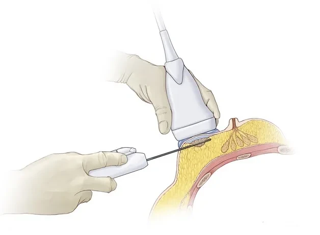 Sinh thiết vú có hỗ trợ hút chân không dưới hướng dẫn siêu âm: Những thông tin cần biết