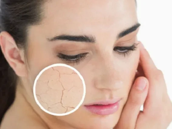 Lý do khiến da khô nứt nẻ trong mùa đông