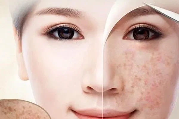 Bí quyết loại bỏ đốm tàn nhang hiệu quả dành cho các chị em