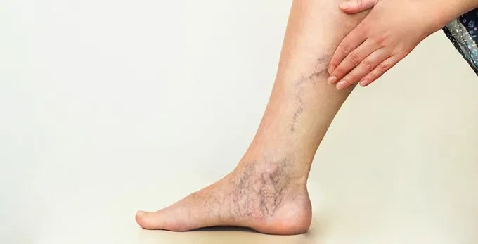 Những liệu pháp tự nhiên chữa suy giãn tĩnh mạch