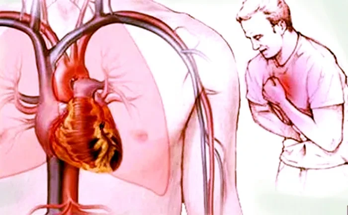 Tổng quan về bệnh mạch vành