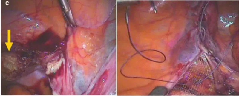 Điều trị sa tạng chậu bằng phẫu thuật nội soi