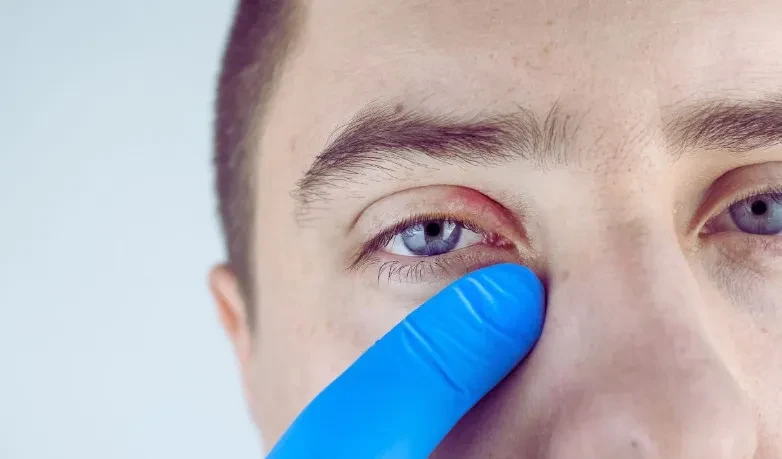 Biện pháp điều trị viêm bờ mi mắt đơn giản, hiệu quả tại nhà