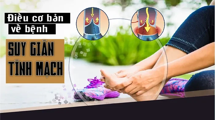 Điều cơ bản về bệnh suy giãn tĩnh mạch