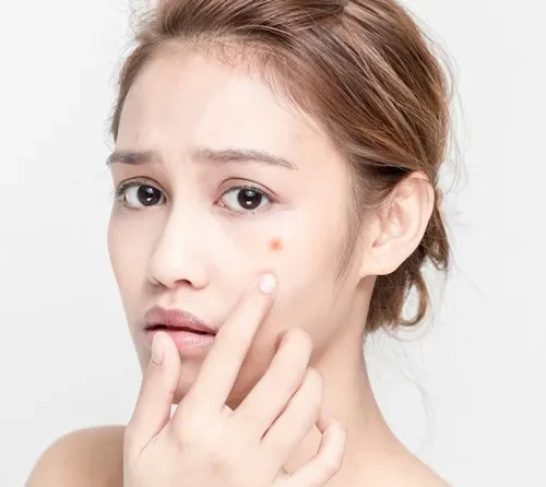 Bí kíp chống nổi mụn trong những ngày tết