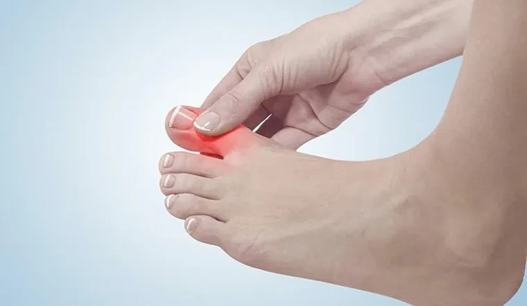 Sử dụng thảo dược tự nhiên để chữa bệnh gout không cần dùng thuốc