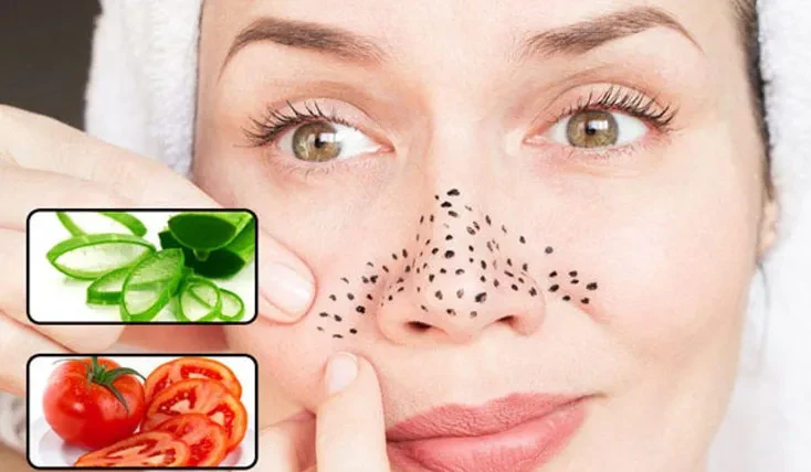 Cách trị mụn đầu đen tại nhà bằng nguyên liệu tự nhiên