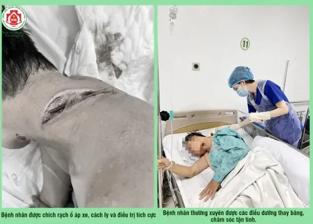 Điều trị cho bệnh nhân bị áp xe vùng cổ gáy trái do mắc bệnh Whitmore