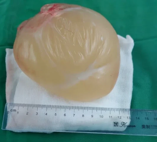 Phẫu thuật cắt bỏ khối nang kích thước lớn vùng bẹn bìu của cụ ông 83 tuổi