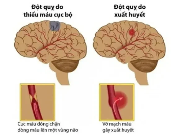 Chuyên gia cảnh báo nguy cơ đột quỵ khi thời tiết trở lạnh