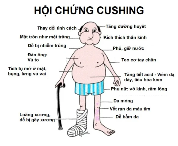 Những điều cần biết về hội chứng cushing