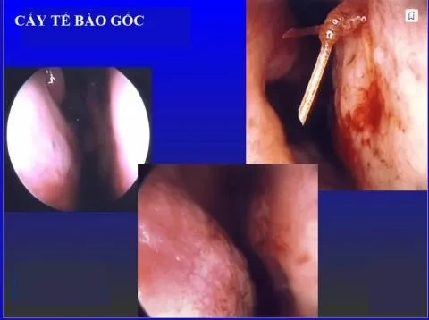 Tái tạo lại chức năng thở của mũi trong hội chứng mũi rỗng bằng tế bào gốc