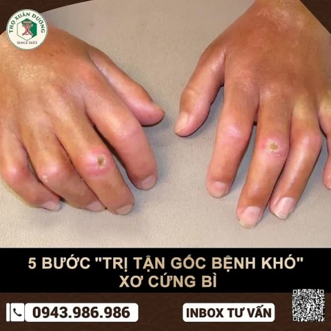 Bệnh phổi kẽ và tăng huyết áp phổi phát triển ở những người mắc bệnh xơ cứng hệ thống
