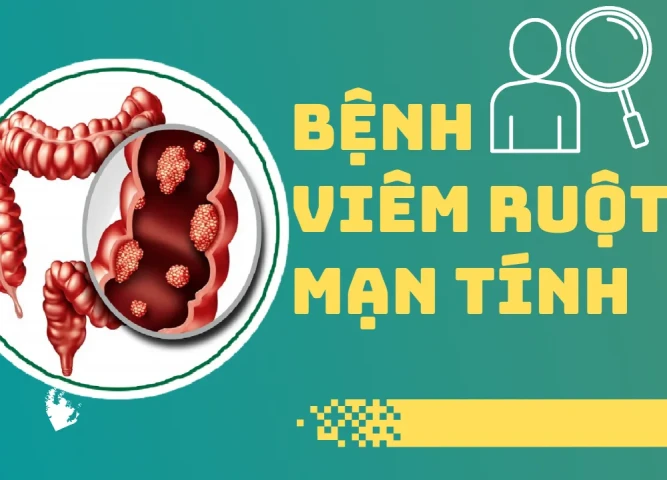 Bệnh viêm ruột mạn tính