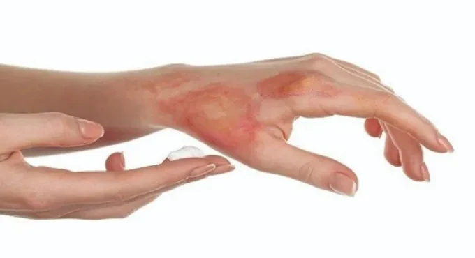 Vitamin D giúp vết thương do bỏng mau lành