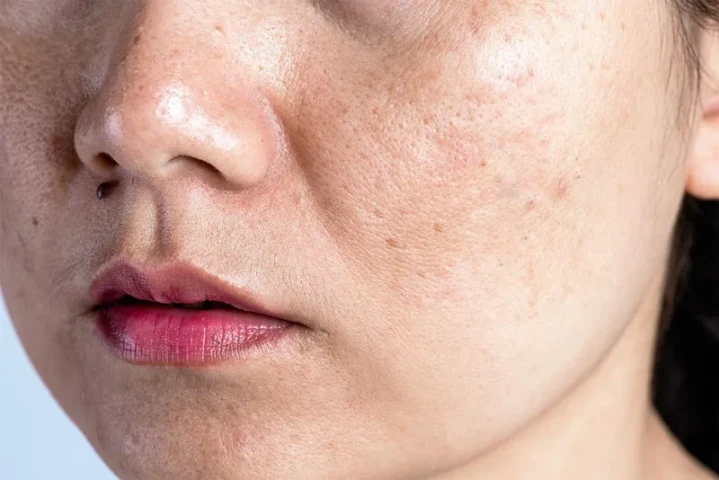 Vì sao nám da thường phát triển mạnh vào mùa đông?