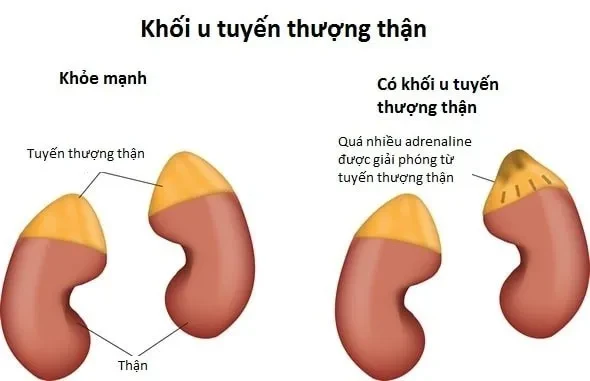 Chế độ dinh dưỡng cho người bệnh sau cắt u tuyến thượng thận
