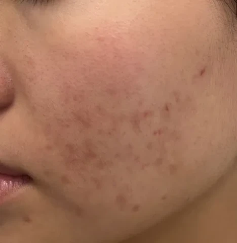 Chuyên gia khuyến cáo không nên thực hiện peel da tại nhà