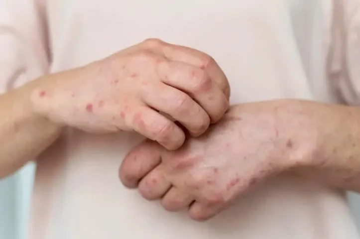 Bộ Y tế yêu cầu tăng cường phòng, chống bệnh Đậu mùa khỉ