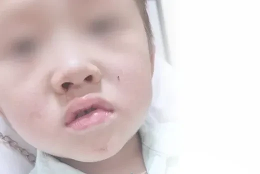 Con vắt dài gần 10 cm sống 2 tháng trong mũi bé trai 4 tuổi