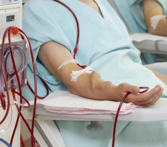 Những điều cần biết về cầu tay dùng lọc máu thận nhân tạo