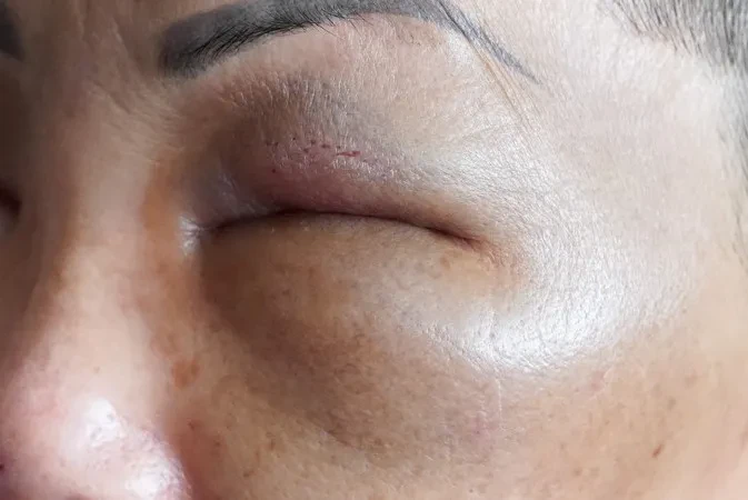Bị lừa tiêm filler giá rẻ ở nhà nghỉ, bệnh nhân bị biến chứng và mất sạch tài sản
