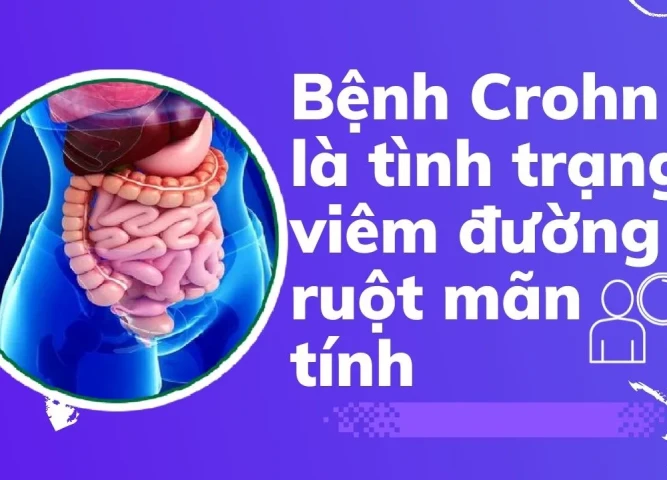 Bệnh Crohn là tình trạng viêm đường ruột mãn tính