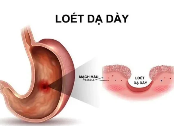 Những dấu hiệu thầm lặng cảnh báo loét dạ dày