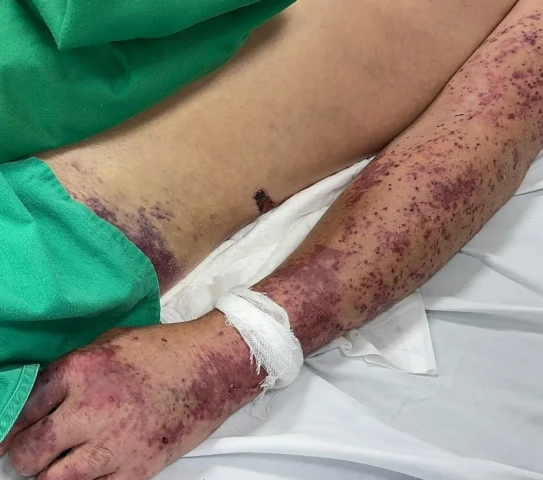 Thêm một người đàn ông nhiễm khuẩn huyết có sốc do Liên cầu lợn