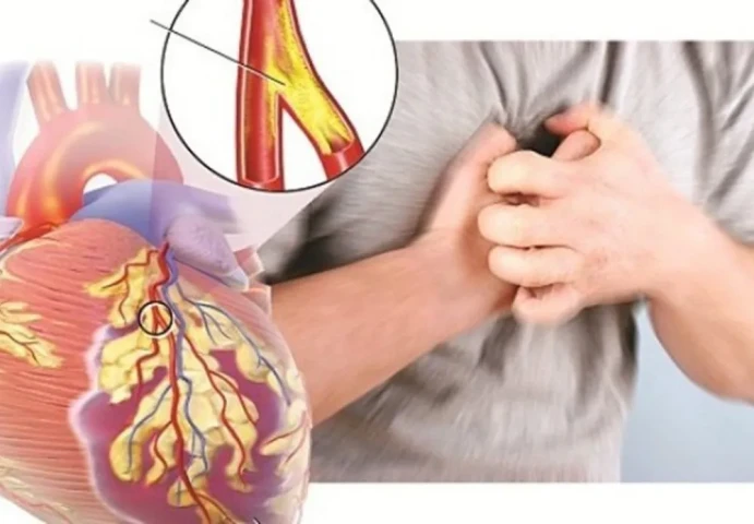 Bệnh động mạch vành và những biến chứng khó lường