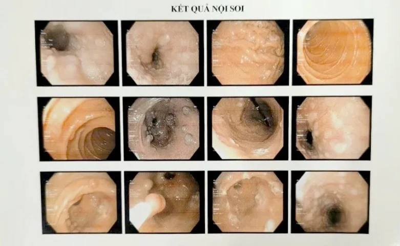 Trường hợp hiếm gặp: Đa polyp dạ dày – Hội chứng Cowden