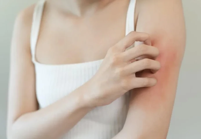 Hiệu quả của liệu pháp Ozone trong điều trị bệnh Lupus