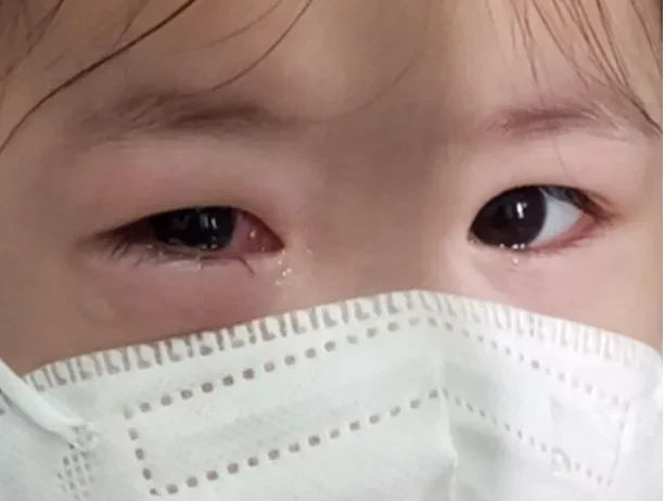 Bác sĩ khuyên những việc cần làm để phòng bệnh đau mắt đỏ cho trẻ mầm non