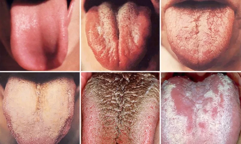 Nhìn lưỡi chẩn bệnh cho bản thân