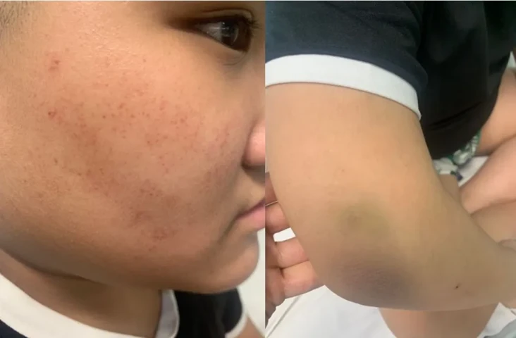 Một số điều cần biết về xuất huyết giảm tiểu cầu miễn dịch ở trẻ em