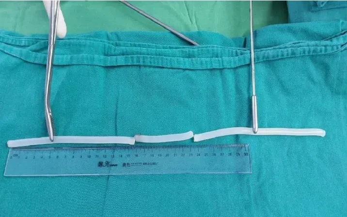 Một bệnh nhân tự nhét một cây keo nến dài 40 cm vào niệu đạo, bàng quang
