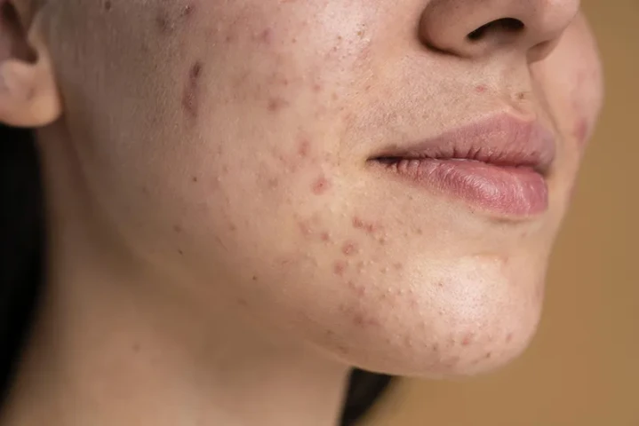 Gợi ý cách làm sạch mụn và vết thâm trên da