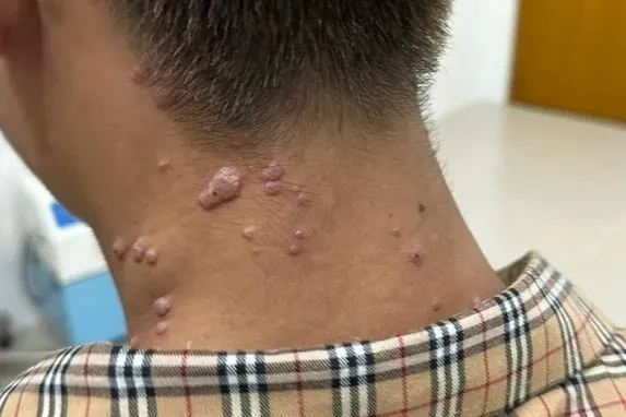 Đồng Nai ghi nhận thêm một ca nghi mắc đậu mùa khỉ