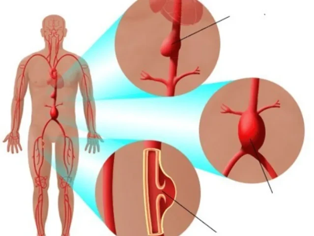 Chẩn đoán và điều trị phình động mạch chủ bụng